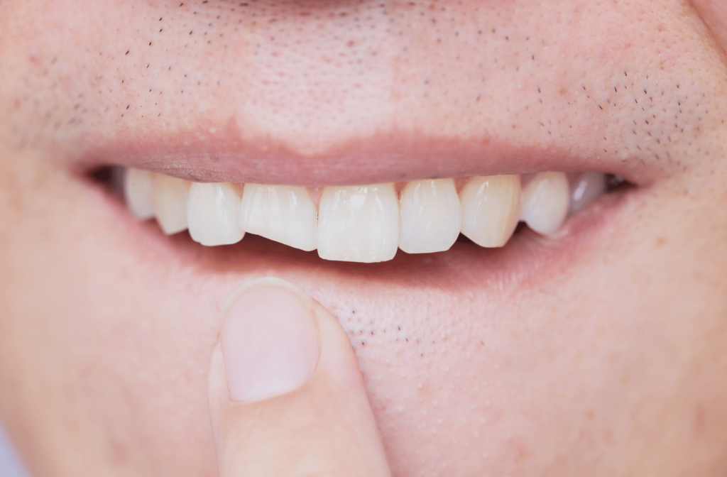 Person pointing at their chipped front tooth that is causing a toothache