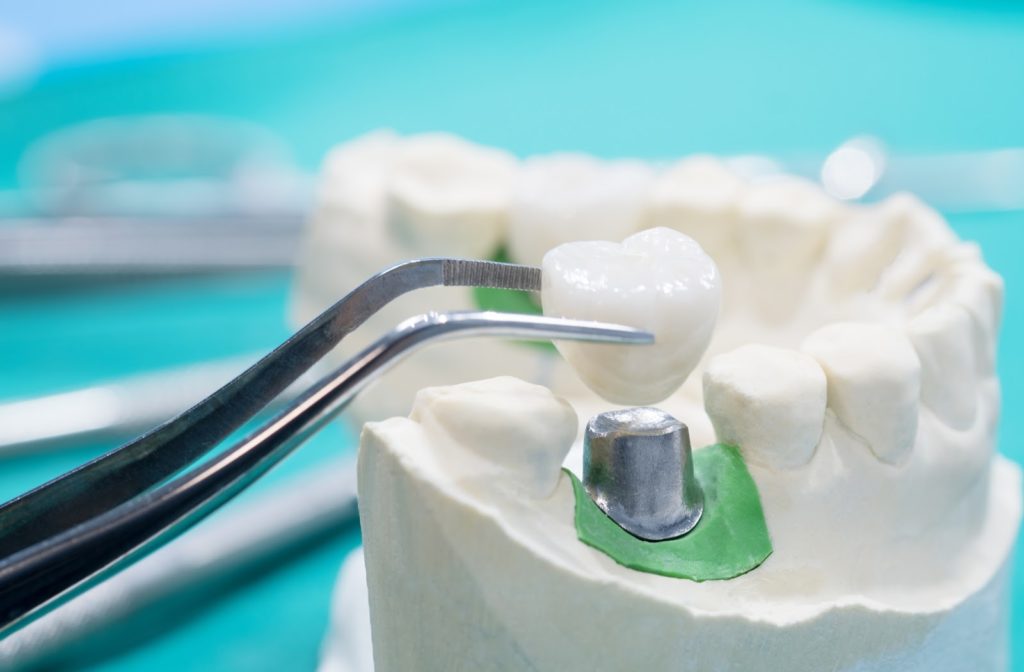 Dental crown being fitted through the use of tooth model.