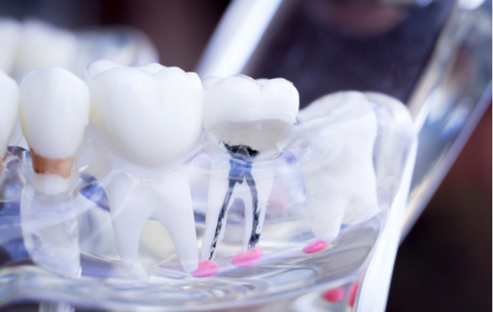 Root canal illustrated through clear 3D model of teeth
